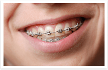 braces without brackets