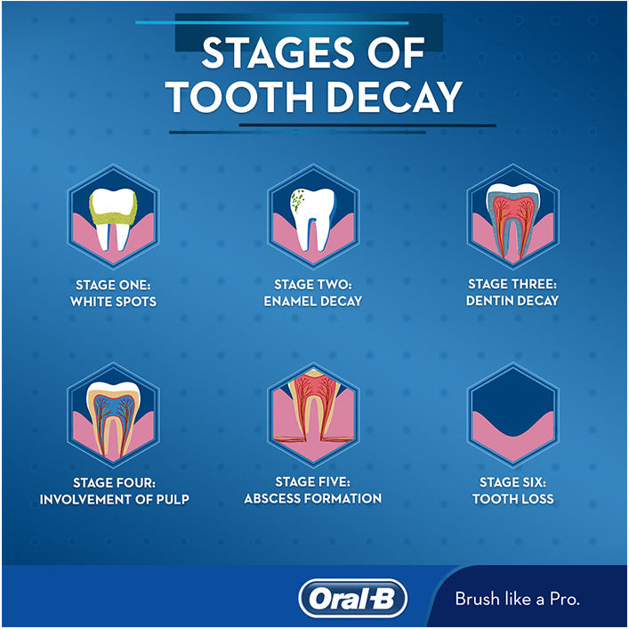 tooth decay stages five stage spots dental cavities oral identify dentist health prevent