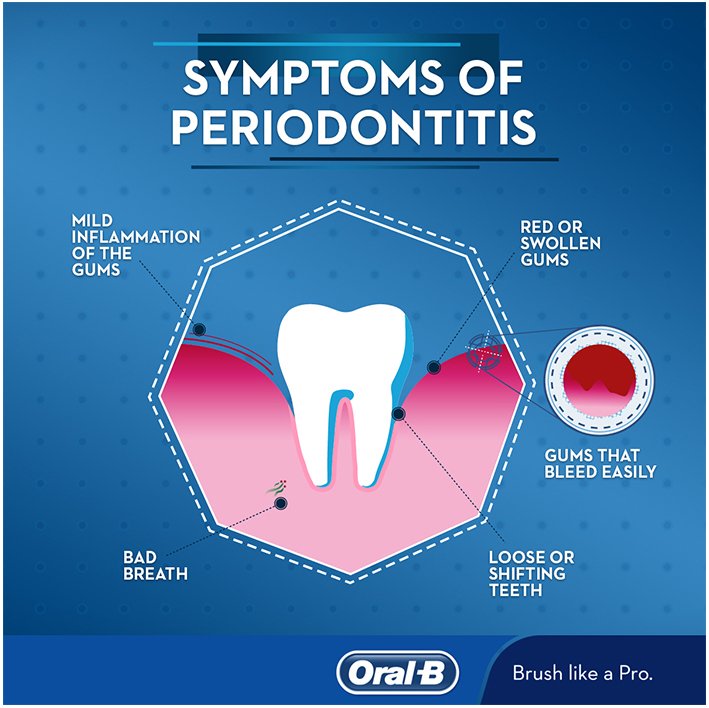 What Is Periodontitis Treatments Signs And Symptoms Oral B